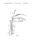 Side-by-side lacrimal intubation threader device diagram and image