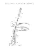 Side-by-side lacrimal intubation threader device diagram and image