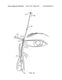 Side-by-side lacrimal intubation threader device diagram and image