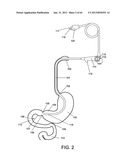 DELIVERY DEVICES AND METHODS FOR GASTROINTESTINAL IMPLANTS diagram and image