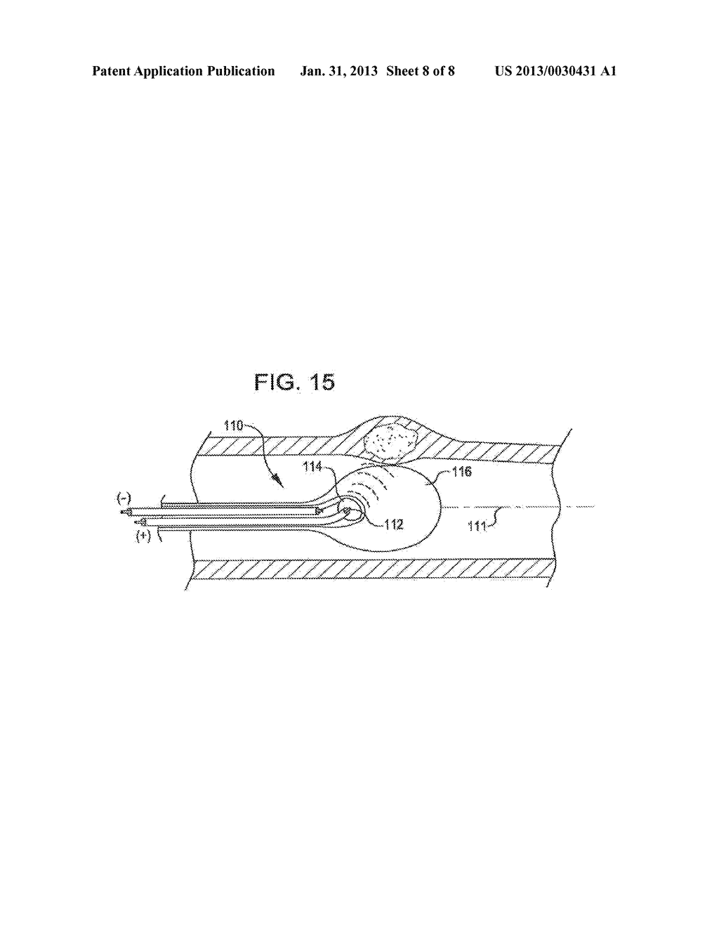 SHOCK WAVE BALLOON CATHETER SYSTEM WITH OFF CENTER SHOCK WAVE GENERATOR - diagram, schematic, and image 09