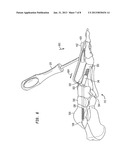 FIXATION SYSTEM, AN INTRAMEDULLARY FIXATION ASSEMBLY AND METHOD OF USE diagram and image