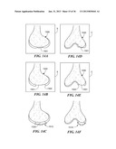 JOINT ARTHROPLASTY DEVICES AND SURGICAL TOOLS diagram and image