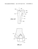 JOINT ARTHROPLASTY DEVICES AND SURGICAL TOOLS diagram and image