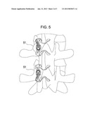 CROSSOVER SPINOUS PROCESS IMPLANT diagram and image