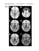 METHOD FOR DEEP BRAIN STIMULATION TARGETING BASED ON BRAIN CONNECTIVITY diagram and image