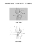 APPARATUS AND METHOD FOR LIGAMENT RECONSTRUCTION diagram and image