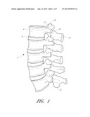 APPARATUS FOR PROMOTING MOVEMENT OF NUTRIENTS TO INTERVERTEBRAL SPACE AND     METHOD OF USE diagram and image