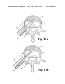 METHODS AND INSTRUMENTS FOR ENDOSCOPIC INTERBODY SURGICAL TECHNIQUES diagram and image