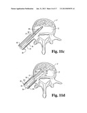 METHODS AND INSTRUMENTS FOR ENDOSCOPIC INTERBODY SURGICAL TECHNIQUES diagram and image