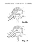 METHODS AND INSTRUMENTS FOR ENDOSCOPIC INTERBODY SURGICAL TECHNIQUES diagram and image