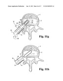 METHODS AND INSTRUMENTS FOR ENDOSCOPIC INTERBODY SURGICAL TECHNIQUES diagram and image