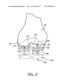 Method And Apparatus For Positioning A Multiple Piece Prosthesis diagram and image