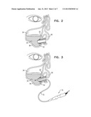 SINUS STENT diagram and image