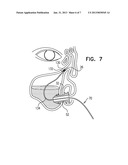 SINUS STENT diagram and image