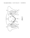 IMPLANTABLE DEVICES, TOOLS AND METHODS FOR ANATOMICAL SUPPORT diagram and image