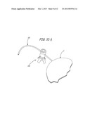 IMPLANTABLE DEVICES, TOOLS AND METHODS FOR ANATOMICAL SUPPORT diagram and image