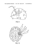 MULTI-DIRECTIONAL MICROFLUIDIC DRUG DELIVERY DEVICE diagram and image