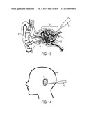 MULTI-DIRECTIONAL MICROFLUIDIC DRUG DELIVERY DEVICE diagram and image