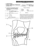 TREATMENT OF SUBCHONDRAL BONE BY BIOCHEMICAL DIAGNOSIS TO PREVENT THE     PROGRESSION OF OSTEOARTHRITIS OF THE JOINT diagram and image