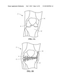 TREATMENT OF SUBCHONDRAL BONE BY BIOCHEMICAL DIAGNOSIS TO PREVENT THE     PROGRESSION OF OSTEOARTHRITIS OF THE JOINT diagram and image