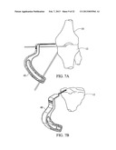 TREATMENT OF SUBCHONDRAL BONE BY BIOCHEMICAL DIAGNOSIS TO PREVENT THE     PROGRESSION OF OSTEOARTHRITIS OF THE JOINT diagram and image