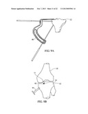 TREATMENT OF SUBCHONDRAL BONE BY BIOCHEMICAL DIAGNOSIS TO PREVENT THE     PROGRESSION OF OSTEOARTHRITIS OF THE JOINT diagram and image