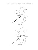 TREATMENT OF SUBCHONDRAL BONE BY BIOCHEMICAL DIAGNOSIS TO PREVENT THE     PROGRESSION OF OSTEOARTHRITIS OF THE JOINT diagram and image