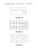 SYSTEM AND METHOD FOR MAPPING GASTRO-INTESTINAL ELECTRICAL ACTIVITY diagram and image