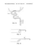 METHODS AND SYSTEMS FOR TREATMENT OF ACUTE ISCHEMIC STROKE diagram and image