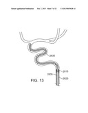 METHODS AND SYSTEMS FOR TREATMENT OF ACUTE ISCHEMIC STROKE diagram and image