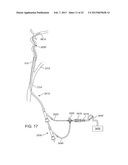 METHODS AND SYSTEMS FOR TREATMENT OF ACUTE ISCHEMIC STROKE diagram and image