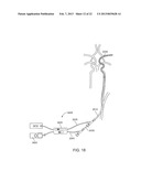 METHODS AND SYSTEMS FOR TREATMENT OF ACUTE ISCHEMIC STROKE diagram and image