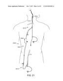 METHODS AND SYSTEMS FOR TREATMENT OF ACUTE ISCHEMIC STROKE diagram and image