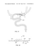 METHODS AND SYSTEMS FOR TREATMENT OF ACUTE ISCHEMIC STROKE diagram and image