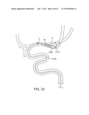 METHODS AND SYSTEMS FOR TREATMENT OF ACUTE ISCHEMIC STROKE diagram and image