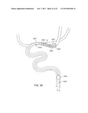 METHODS AND SYSTEMS FOR TREATMENT OF ACUTE ISCHEMIC STROKE diagram and image