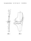 COMBINATION LIGAMENT TENSIONER AND ALIGNMENT DEVICE diagram and image