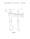 COMBINATION LIGAMENT TENSIONER AND ALIGNMENT DEVICE diagram and image