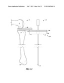 COMBINATION LIGAMENT TENSIONER AND ALIGNMENT DEVICE diagram and image