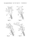 Spinal Implants and Spinal Fixings diagram and image