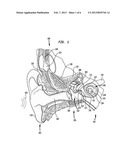 IMPLANTABLE MICROPHONE FOR AN IMPLANTABLE HEARING PROSTHESIS diagram and image