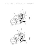 MINIMALLY INVASIVE REPAIR OF HEART VALVE LEAFLETS diagram and image