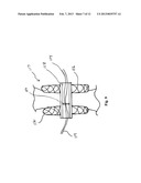 MINIMALLY INVASIVE REPAIR OF HEART VALVE LEAFLETS diagram and image