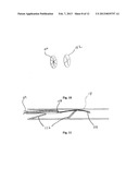 MINIMALLY INVASIVE REPAIR OF HEART VALVE LEAFLETS diagram and image