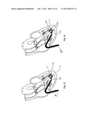 MINIMALLY INVASIVE REPAIR OF HEART VALVE LEAFLETS diagram and image