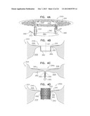 TECHNIQUES FOR PERCUTANEOUS MITRAL VALVE REPLACEMENT AND SEALING diagram and image