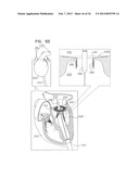 TECHNIQUES FOR PERCUTANEOUS MITRAL VALVE REPLACEMENT AND SEALING diagram and image