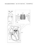 TECHNIQUES FOR PERCUTANEOUS MITRAL VALVE REPLACEMENT AND SEALING diagram and image