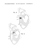 TECHNIQUES FOR PERCUTANEOUS MITRAL VALVE REPLACEMENT AND SEALING diagram and image